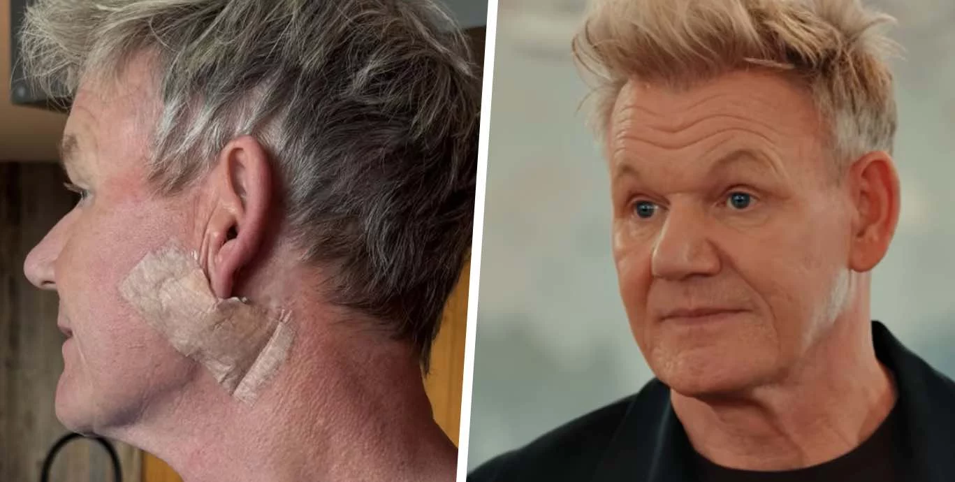 Gordon Ramsay si sottopone a chirurgia per carcinoma: il suo importante messaggio sulla protezione solare