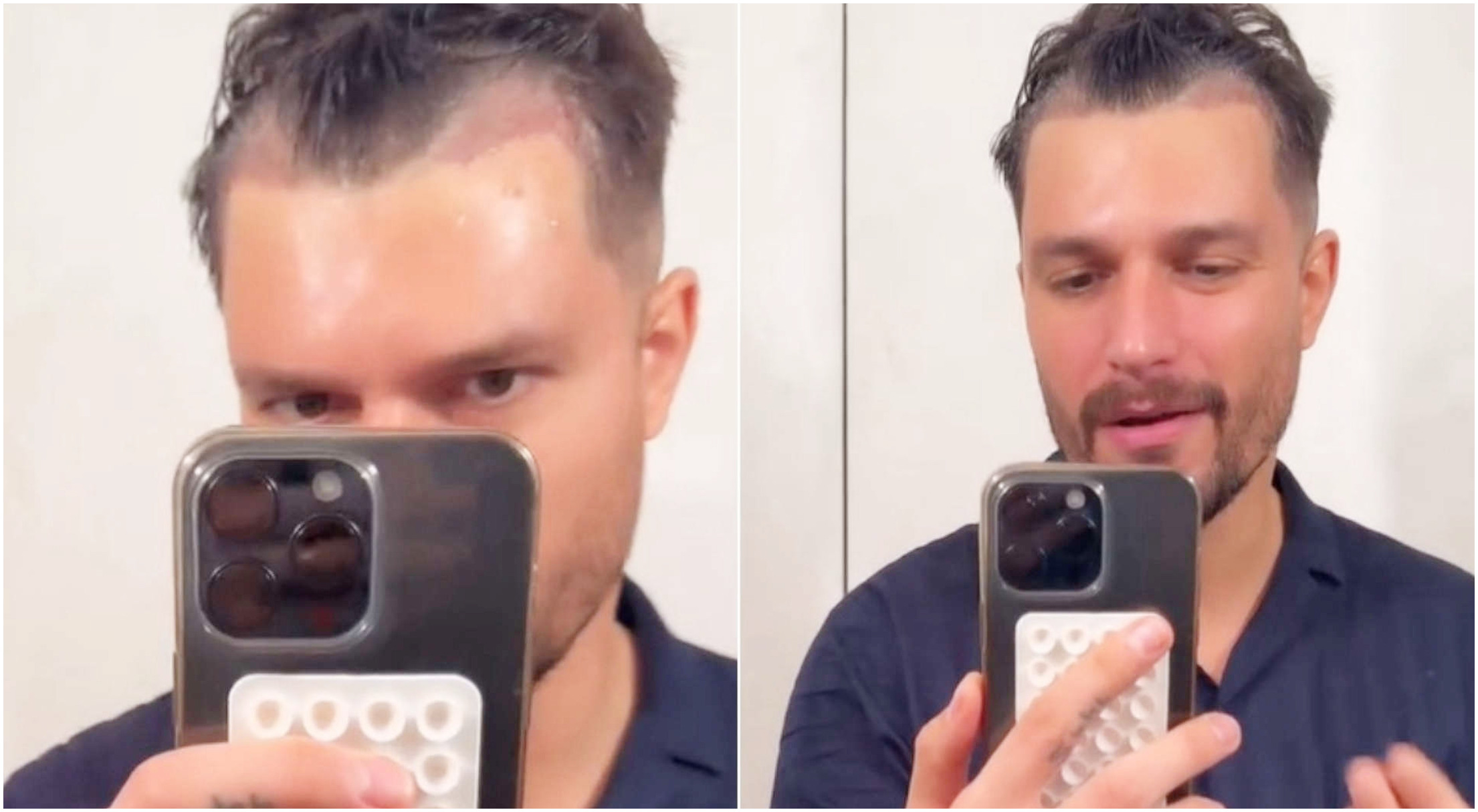 Andrea Zelletta parla del suo intervento di trapianto di capelli e della sorprendente trasformazione