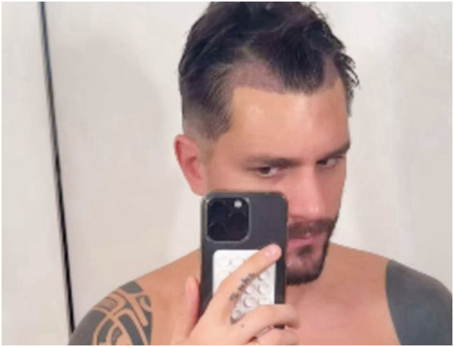 Andrea Zelletta rivela di aver effettuato un trapianto di capelli per migliorare il suo look