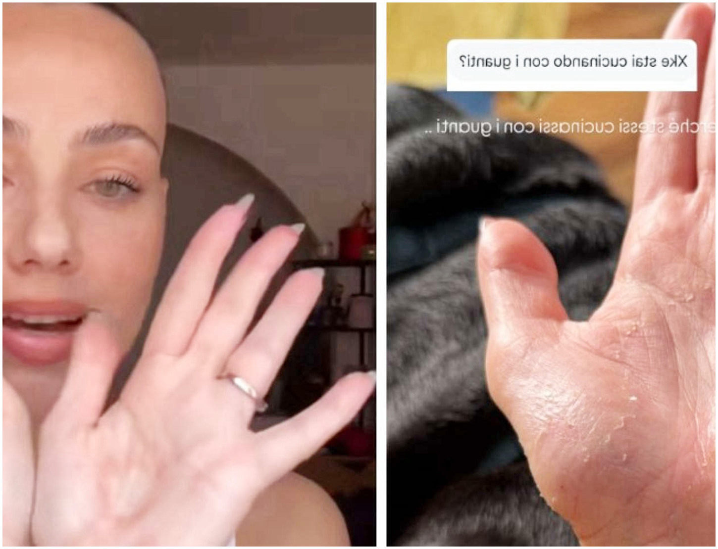 Rosalinda Cannavò rivela il suo problema di salute e mostra le mani in difficoltà con guanti