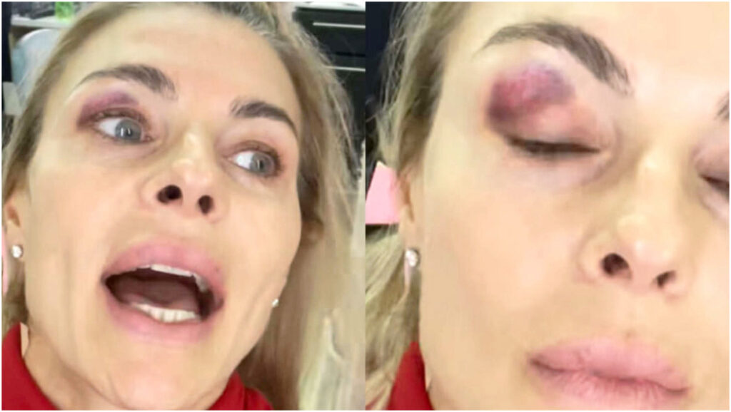 Ballando con le stelle: Martina Colombari presenta un occhio nero dopo un incidente in pista