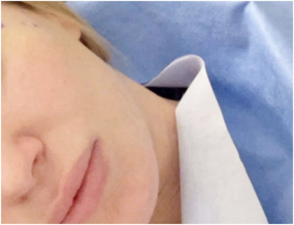 Taylor Mega decide di sottoporsi a un intervento per inserire grasso nelle tempie