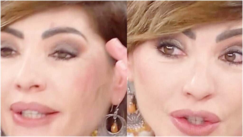 Ilaria Galassi racconta la sua esperienza dopo l’intervento di chirurgia estetica per un disagio personale