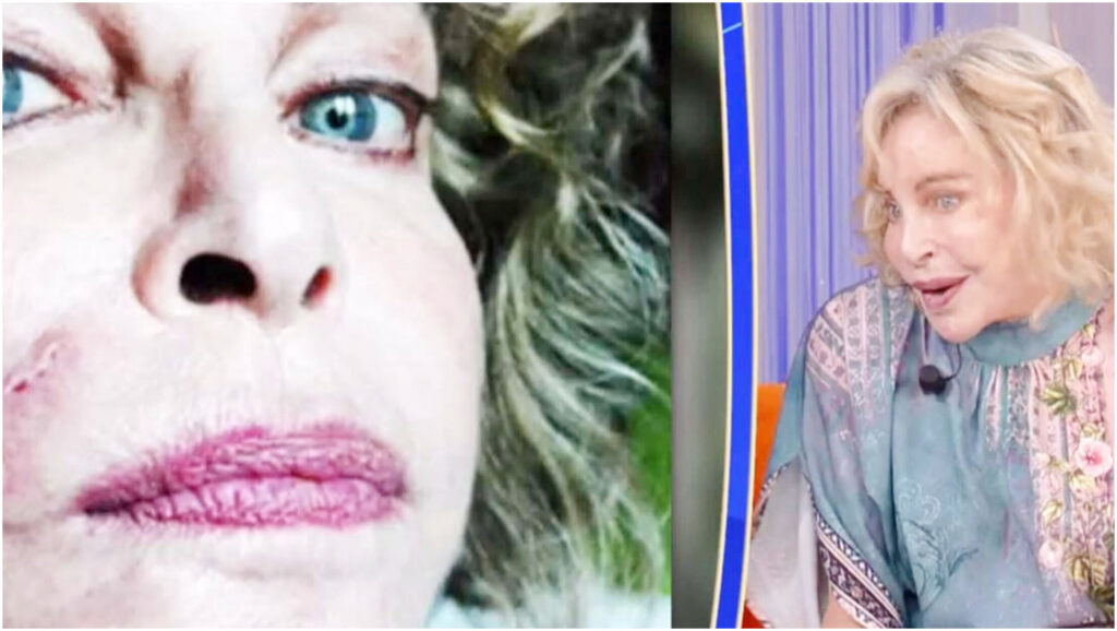 Sydne Rome racconta il drammatico incidente che le ha paralizzato il viso per 20 anni