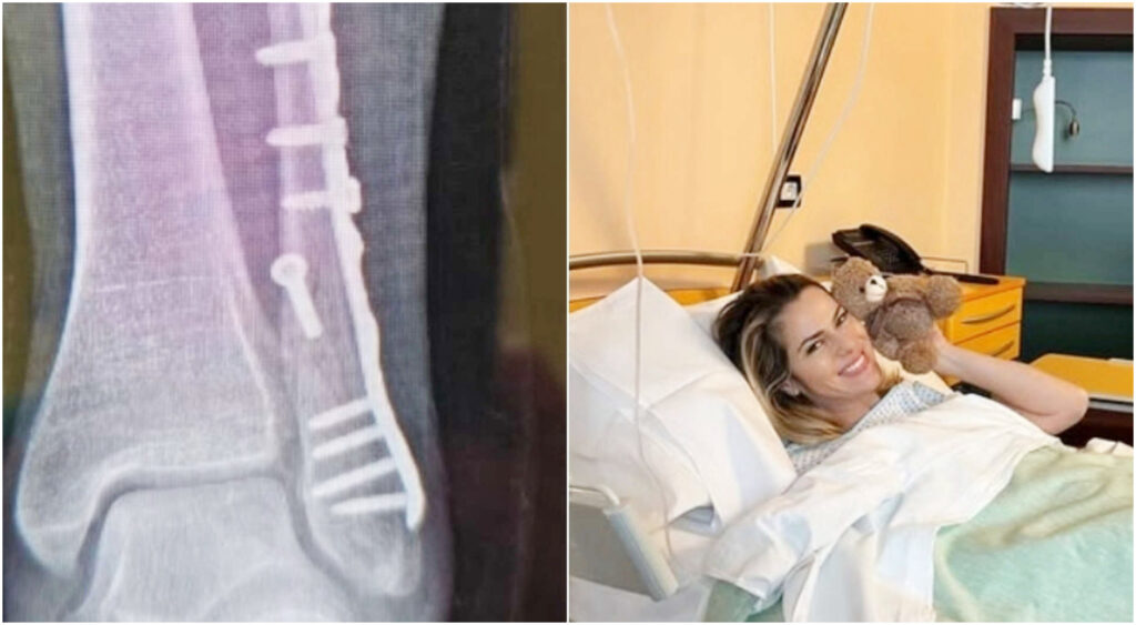 Thais Wiggers sottoposta a intervento chirurgico dopo l’incidente sulla neve: ora ha un piede bionico