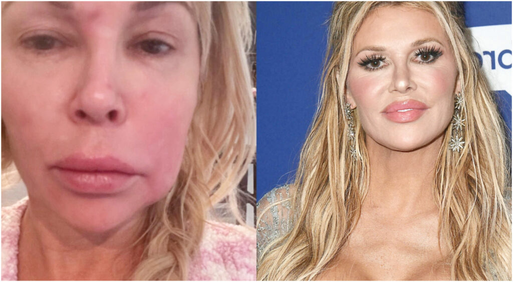 Viso danneggiato da una protesi al seno esplosa: tre anni di cure e un lungo percorso di verità