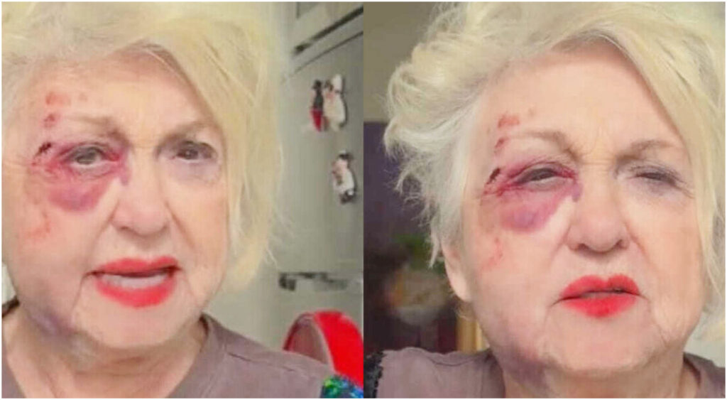 Wanna Marchi investita da un’auto mentre attraversa sulle strisce pedonali a Milano, la denuncia sui social